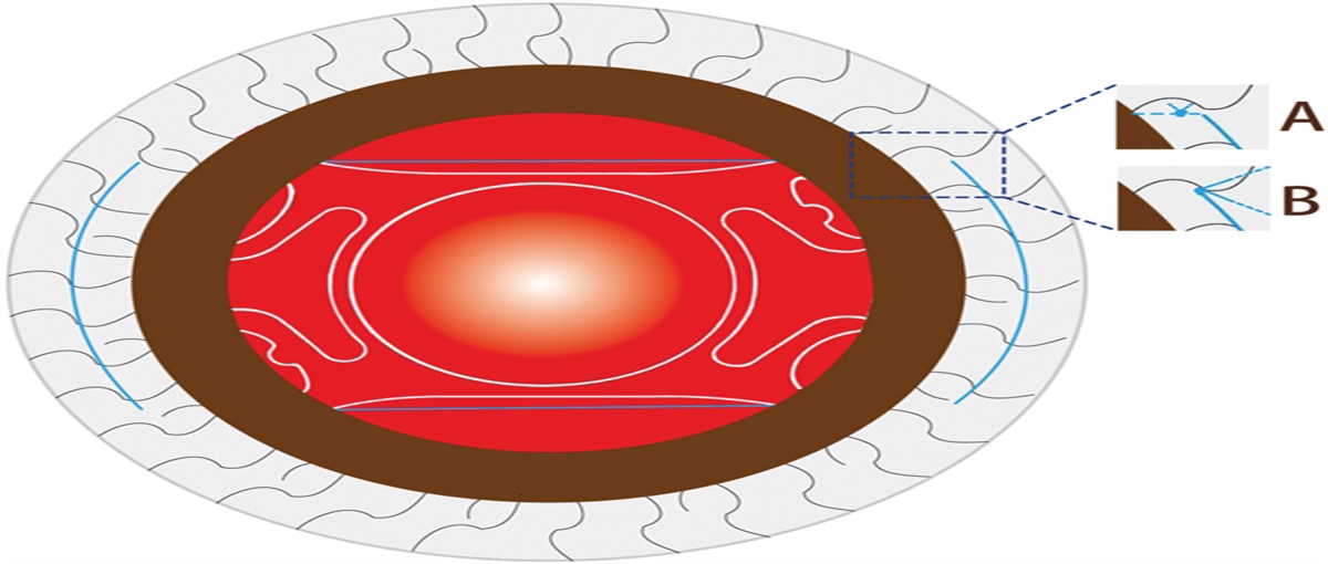 LONG-TERM OUTCOME OF TRANSSCLERAL FOUR-POINT FIXATION OF AKREOS INTRAOCULAR LENS WITH CLOSED CONTINUOUS-LOOP SUTURE