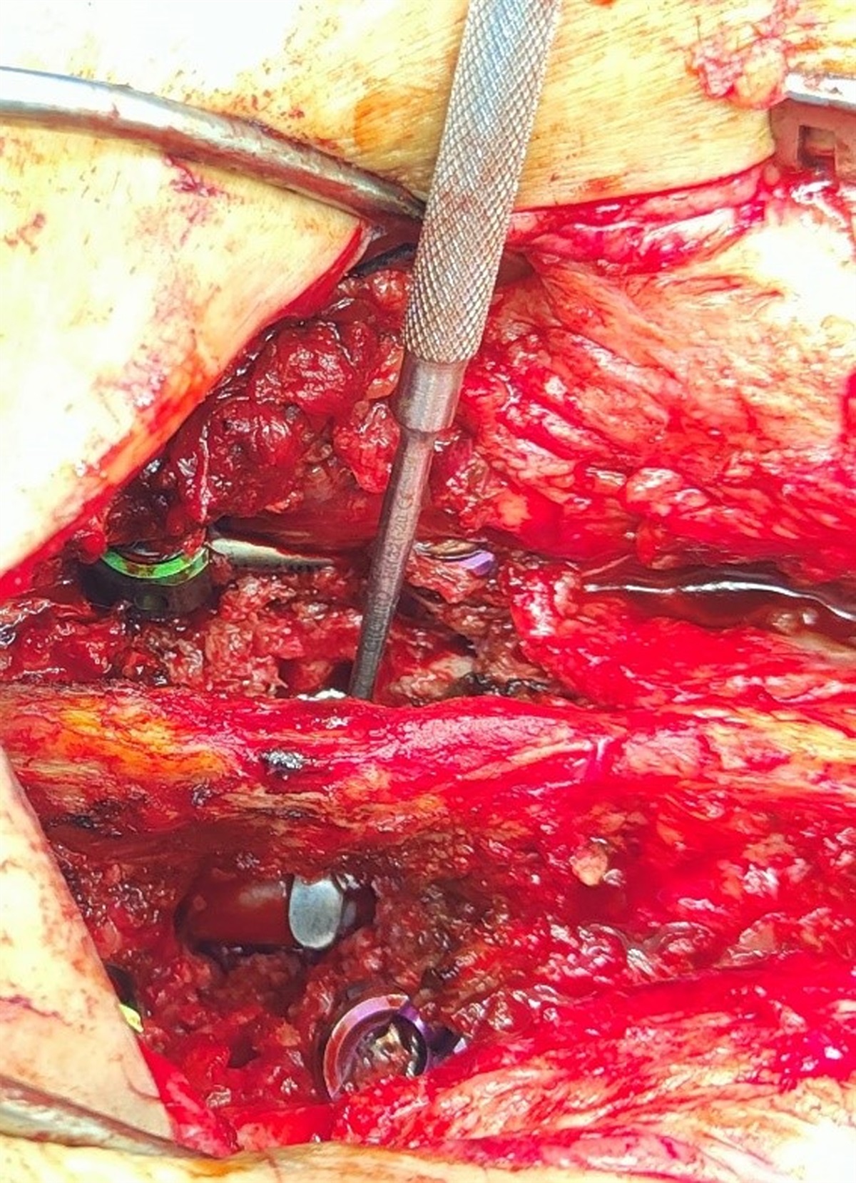 Sublaminar Decompression and Fusion Versus Sublaminar Trimming Laminoplasty: A Retrospective Cohort
