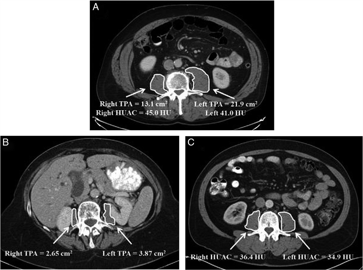 The implications of sarcopenia in the treatment and prognosis of pancreatic cancer