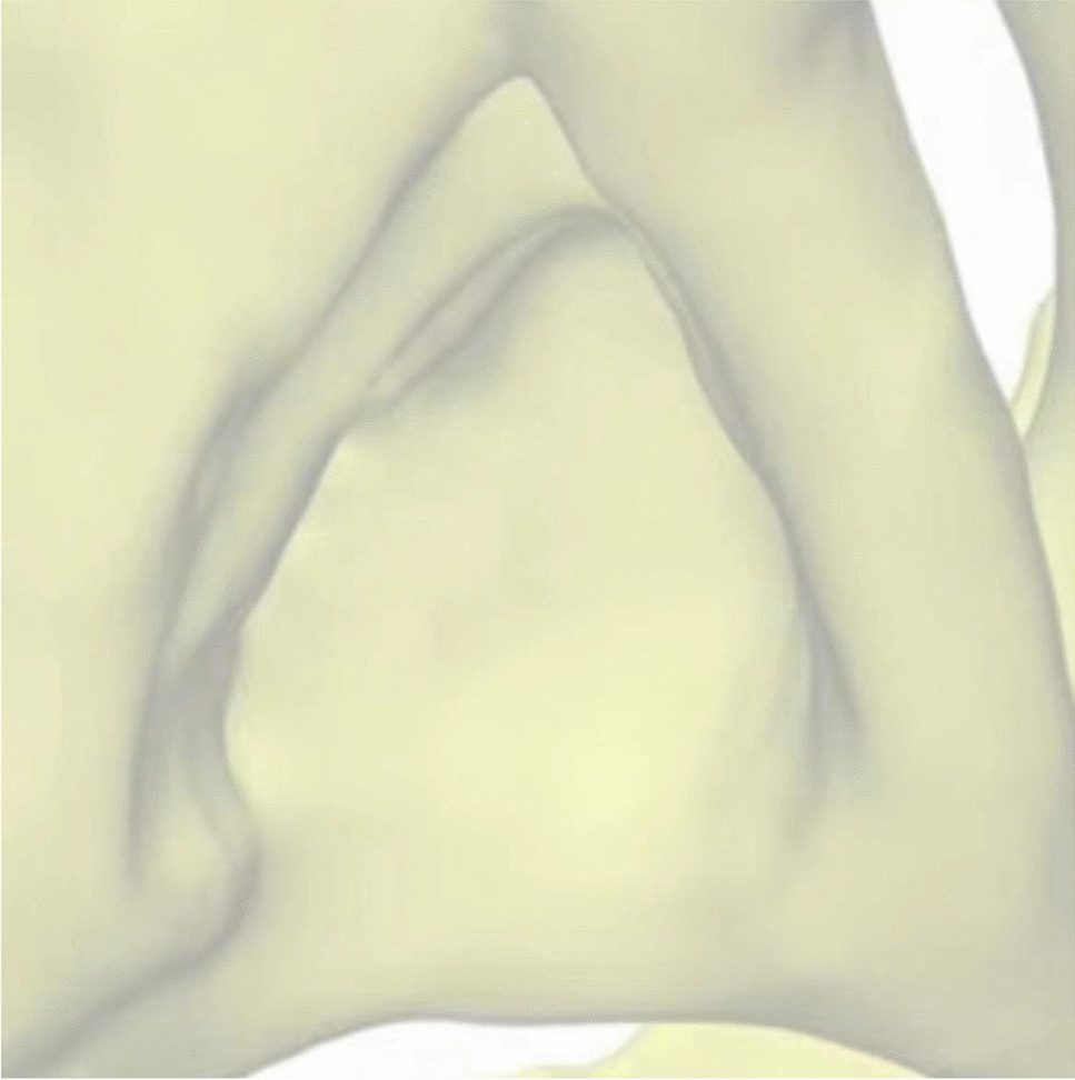 A novel intraoperative acetabular reaming center locating method in total hip arthroplasty for Crowe type IV developmental dysplasia of the hip: a retrospective cohort study