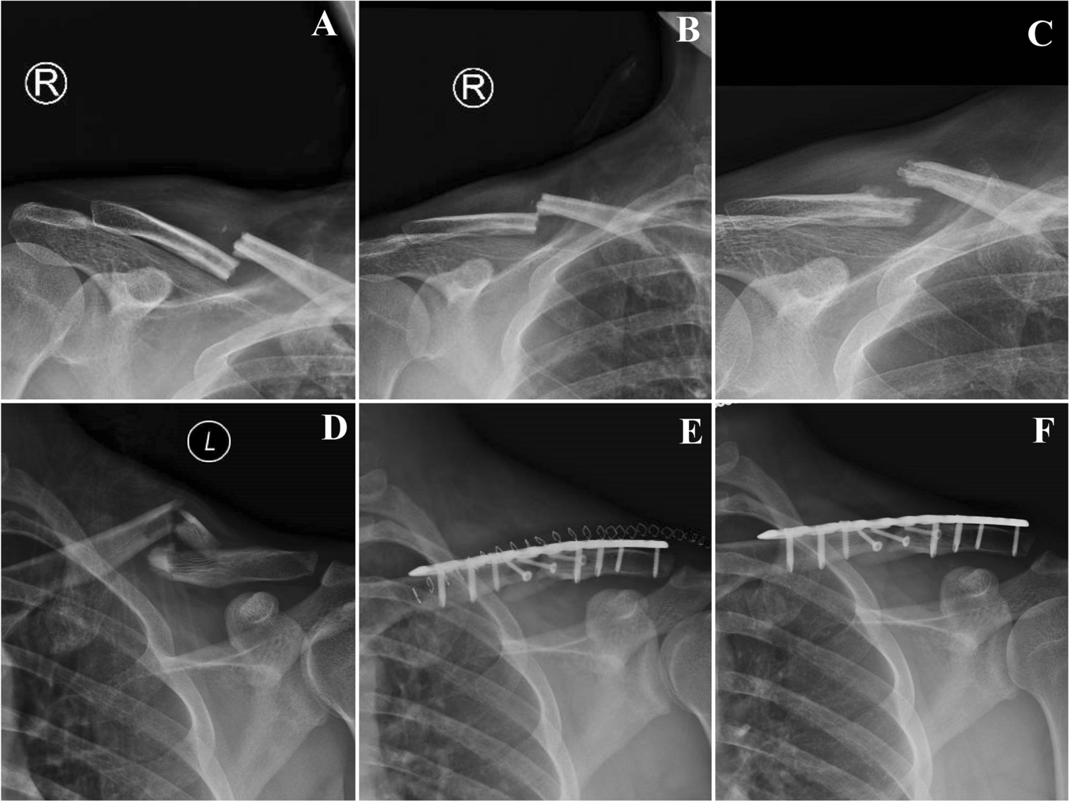 Comprehensive comparison between conservative therapy and surgical management for completely displaced and comminuted mid-shaft clavicle fractures