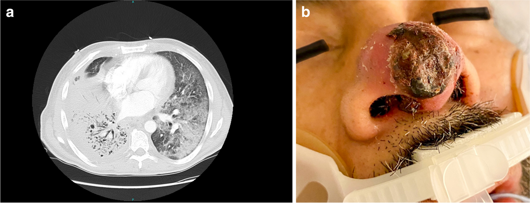 Disseminated Blastomycosis in an Immunocompetent Patient