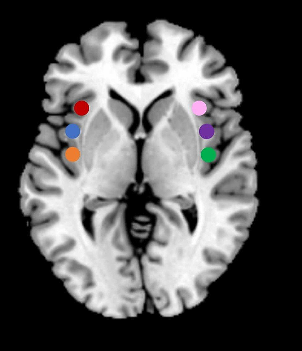 Connectivity of the insular subdivisions differentiates posttraumatic headache-associated from nonheadache-associated mild traumatic brain injury: an arterial spin labelling study