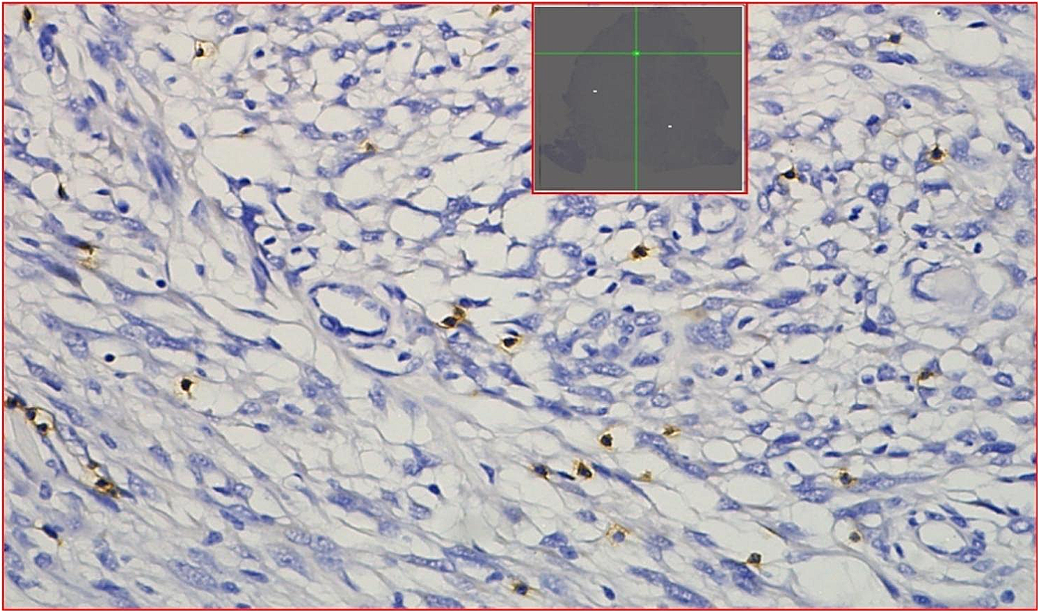 MRI features and tumor-infiltrating CD8 + T cells-based nomogram for predicting meningioma recurrence risk