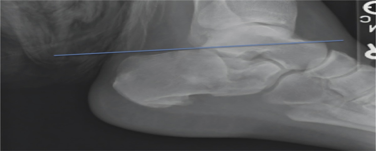 Using the Equatorial Talar Line as a Radiographic Predictor of Sanders Type 3 and 4 Calcaneus Fractures and Lateral Wall Blowout