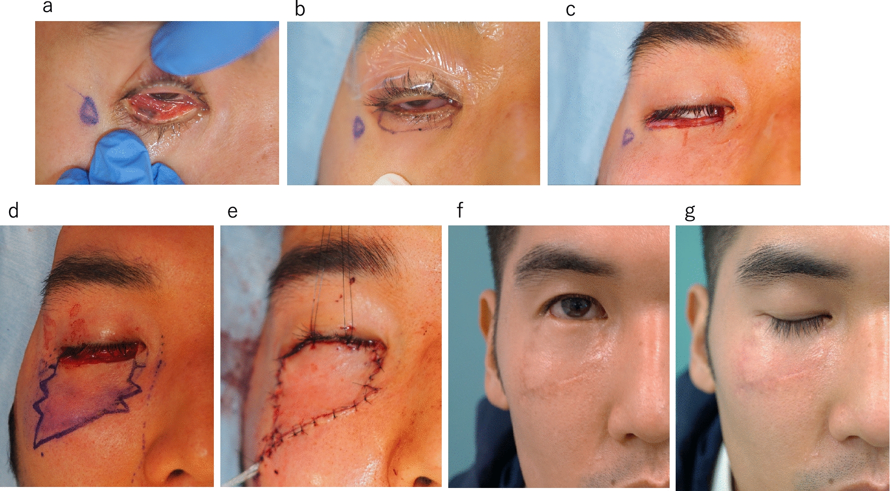 Step ladder VY advancement flap for lower eyelid reconstruction after resection eyelid malignant tumors