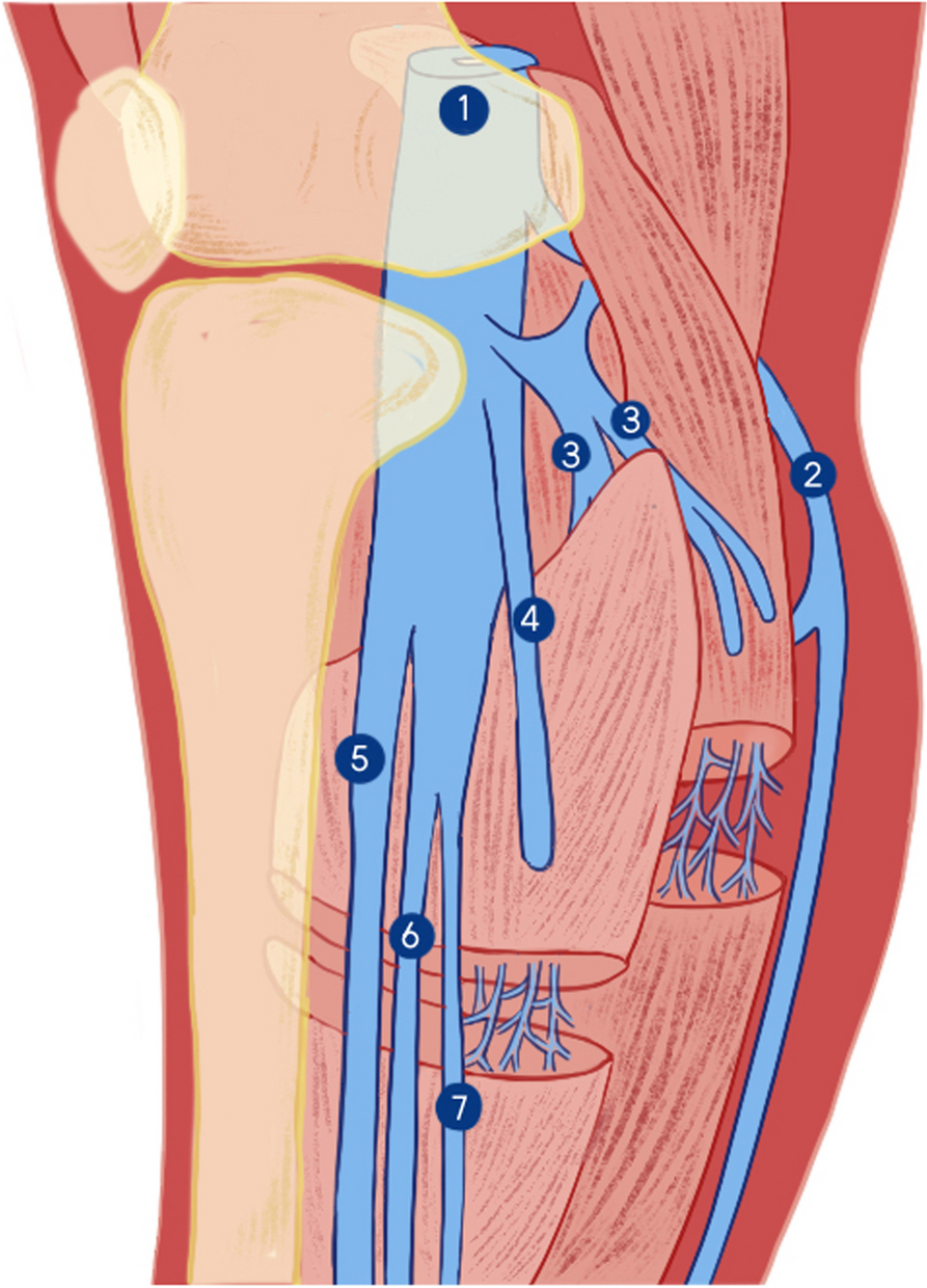 Recurrence in isolated distal DVT after anticoagulation: a systematic review and meta-analysis of axial and muscular venous thrombosis