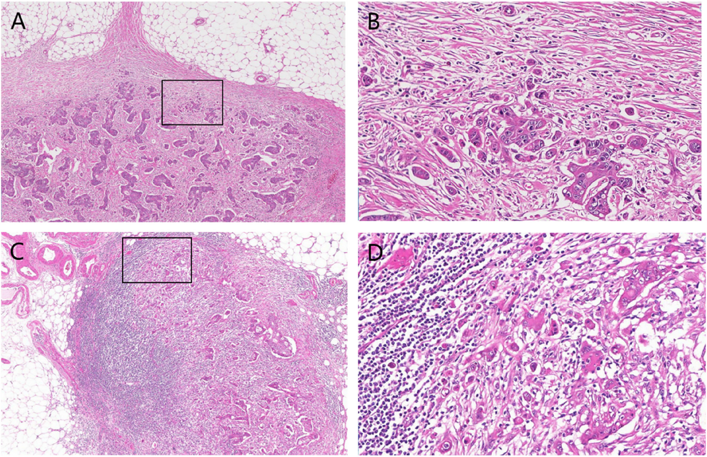 Correlations of pathomorphological parameters between lesions at the invasive front and lymph node metastases in colorectal cancer: a retrospective clinical study