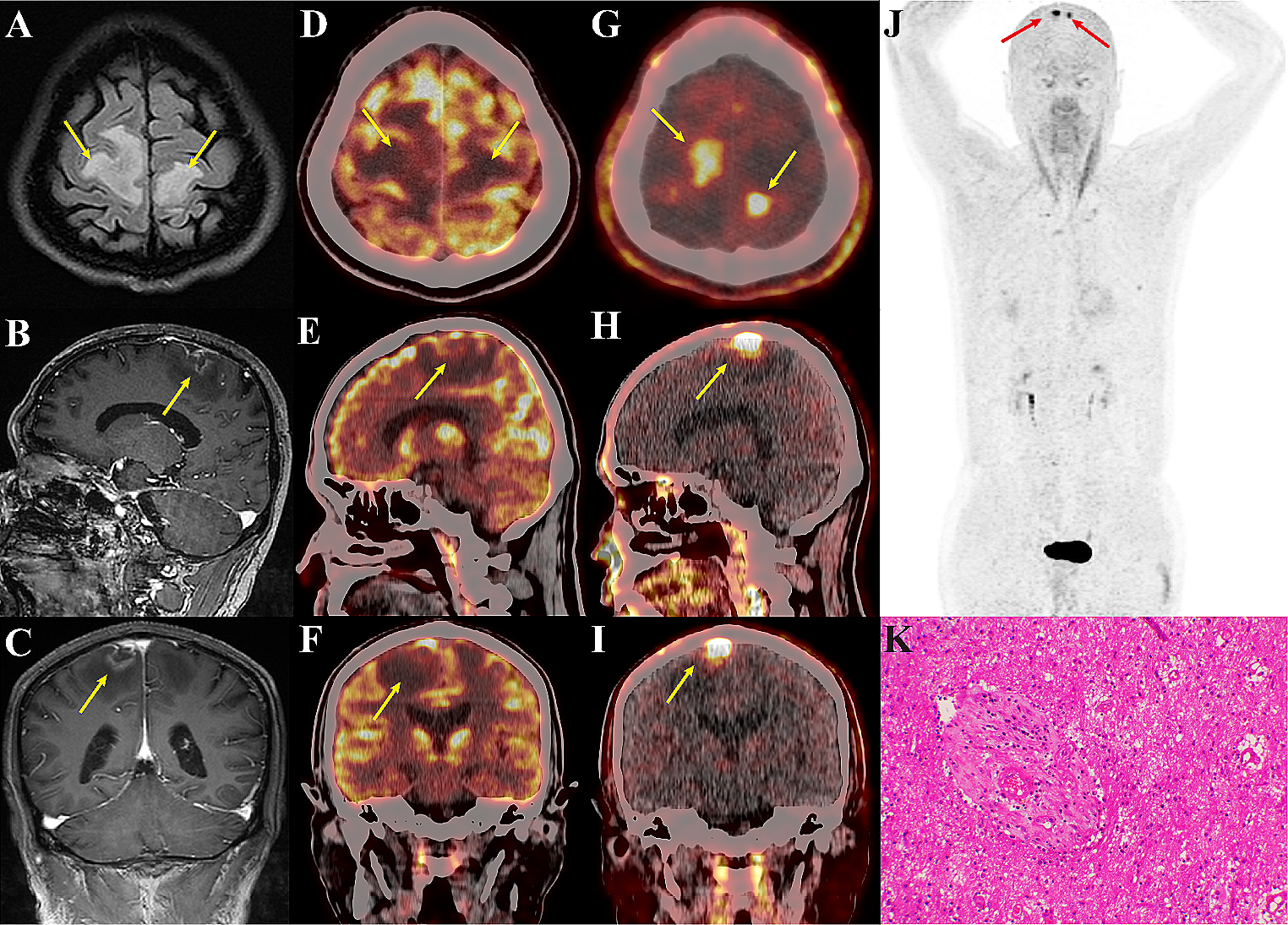 [68Ga]Ga-FAPI-04 PET/CT imaging of a patient with neurosyphilis mimicking intracranial malignant tumor