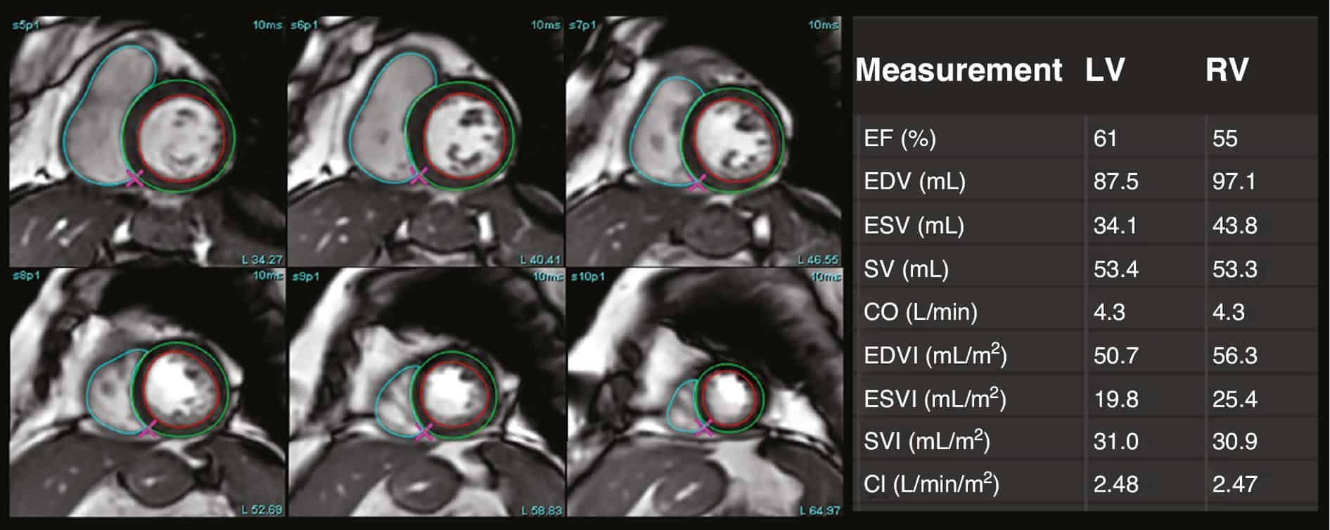 Cardiac Magnetic Resonance Imaging in Heart Failure