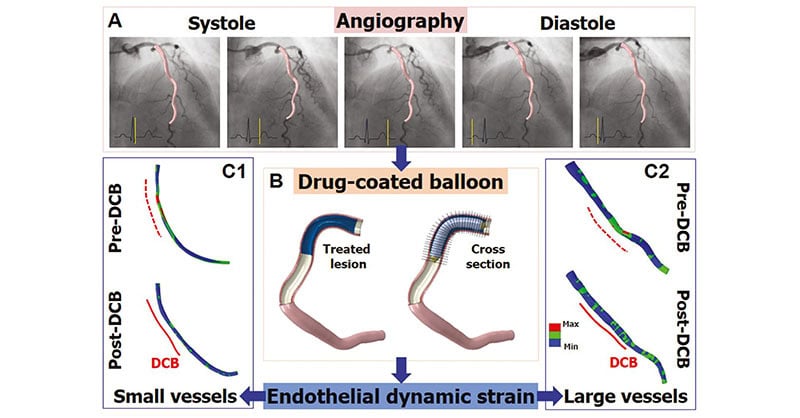 Angiography-Based Computational Modeling for In Vivo Assessment of Endothelial Dynamic Strain in Coronary Arteries with De Novo Lesions: Comparison of Treatment Effects of Drug-Coated Balloons Between Small and Large Arteries