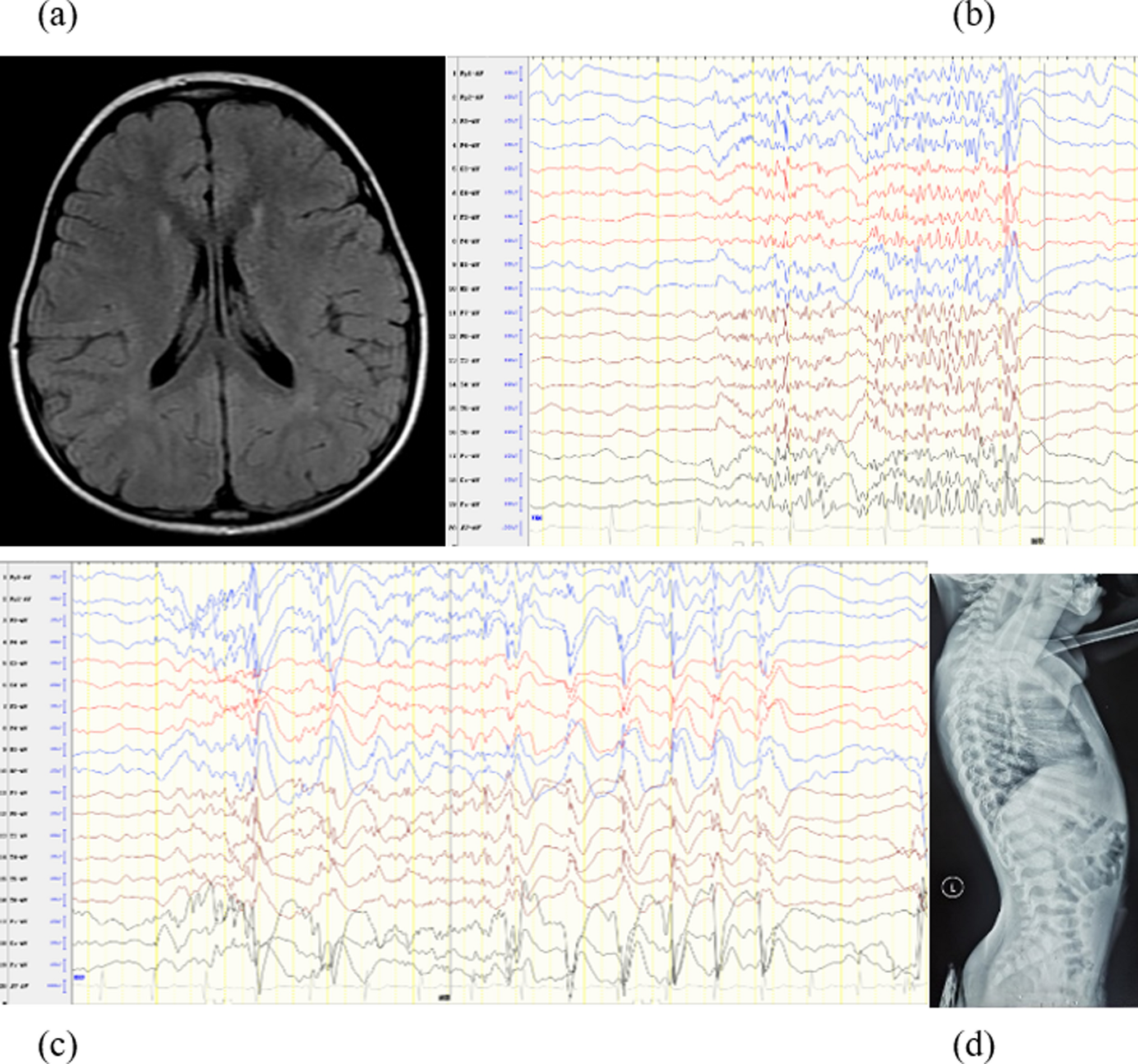 Special clinical entity with 15q26 deletion: a novel case report