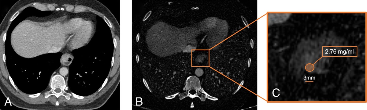 Evaluating Treatment Response in GEJ Adenocarcinoma: The Role of Pretherapeutic and Posttherapeutic Iodine Mapping