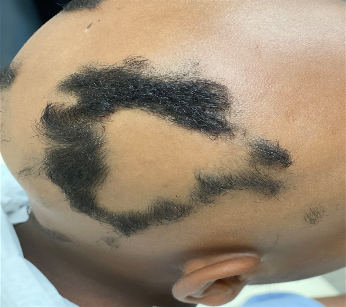 Patchy Hair Loss