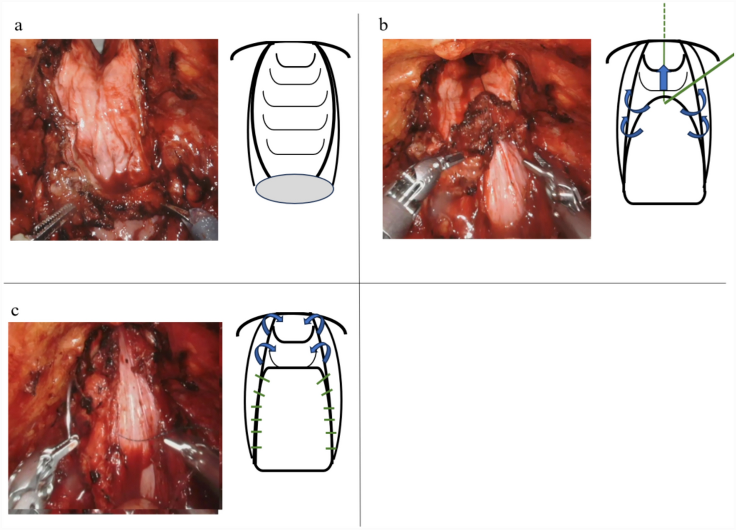 Investigation of risk factors for vaginal dehiscence and development of small bowel evisceration after robot-assisted radical cystectomy for female bladder cancer and an improved vaginal reconstruction technique to prevent its onset