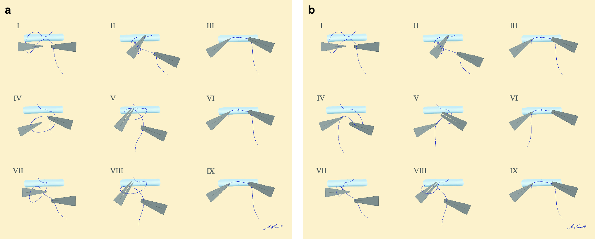 Ideal suturing technique for robot-assisted microsurgical anastomoses