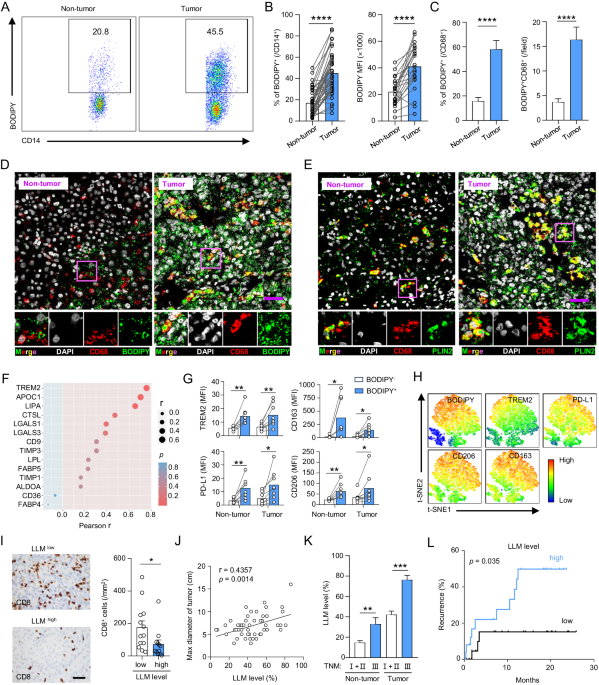 Lipid droplet accumulation mediates macrophage survival and Treg recruitment via the CCL20/CCR6 axis in human hepatocellular carcinoma