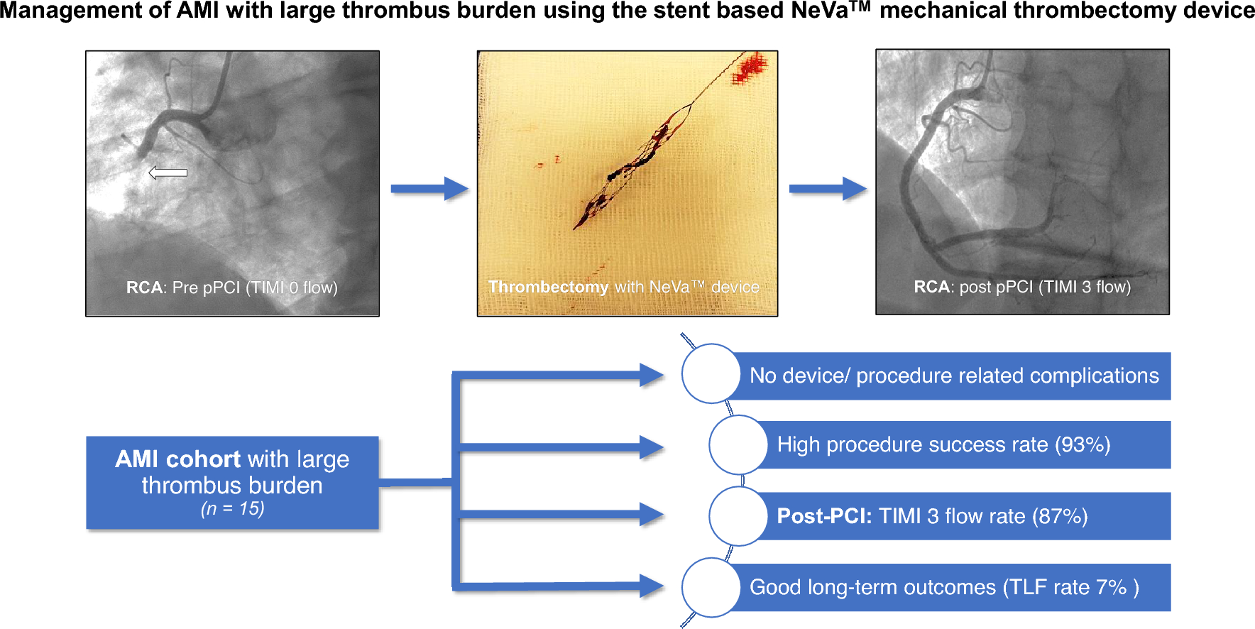 Initial experience with a novel stent-based mechanical thrombectomy device for management of acute myocardial infarction cases with large thrombus burden