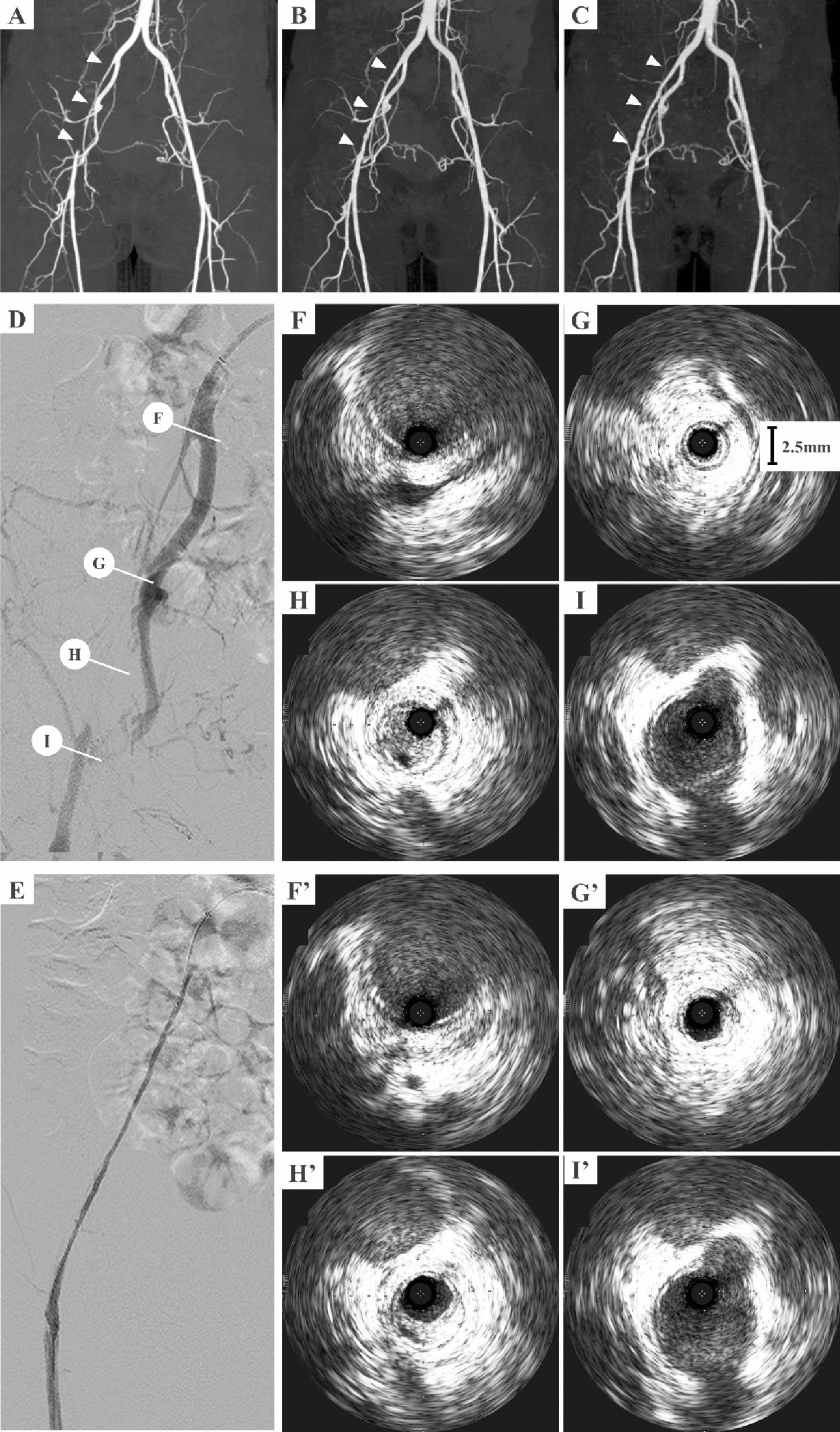 Successful endovascular treatment of an occluded external iliac artery with a minimum outer vessel diameter of 2.5 mm