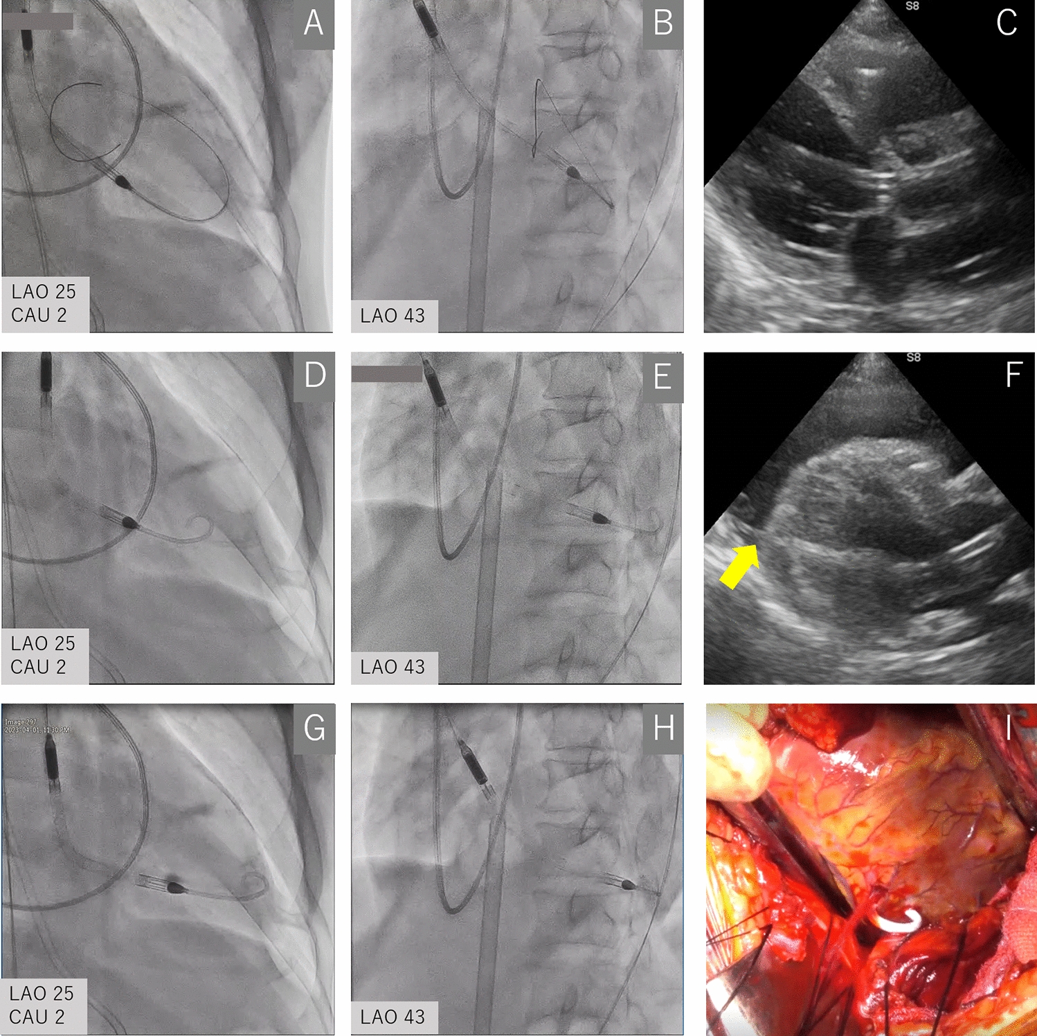 Left ventricular perforation caused by Impella repositioning after wire removal