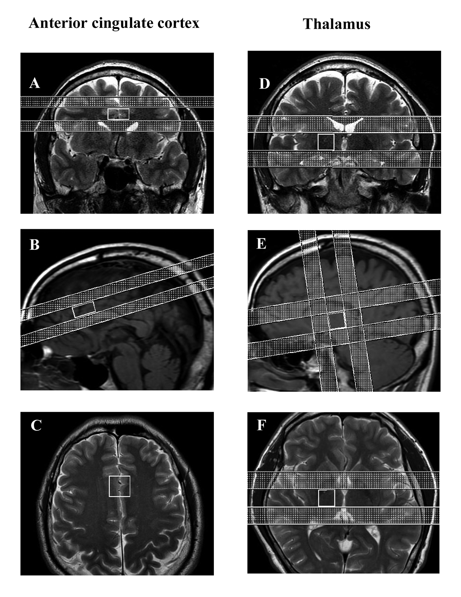 Alterations in metabolites in the anterior cingulate cortex and thalamus and their associations with pain and empathy in patients with chronic mild pain: a preliminary study