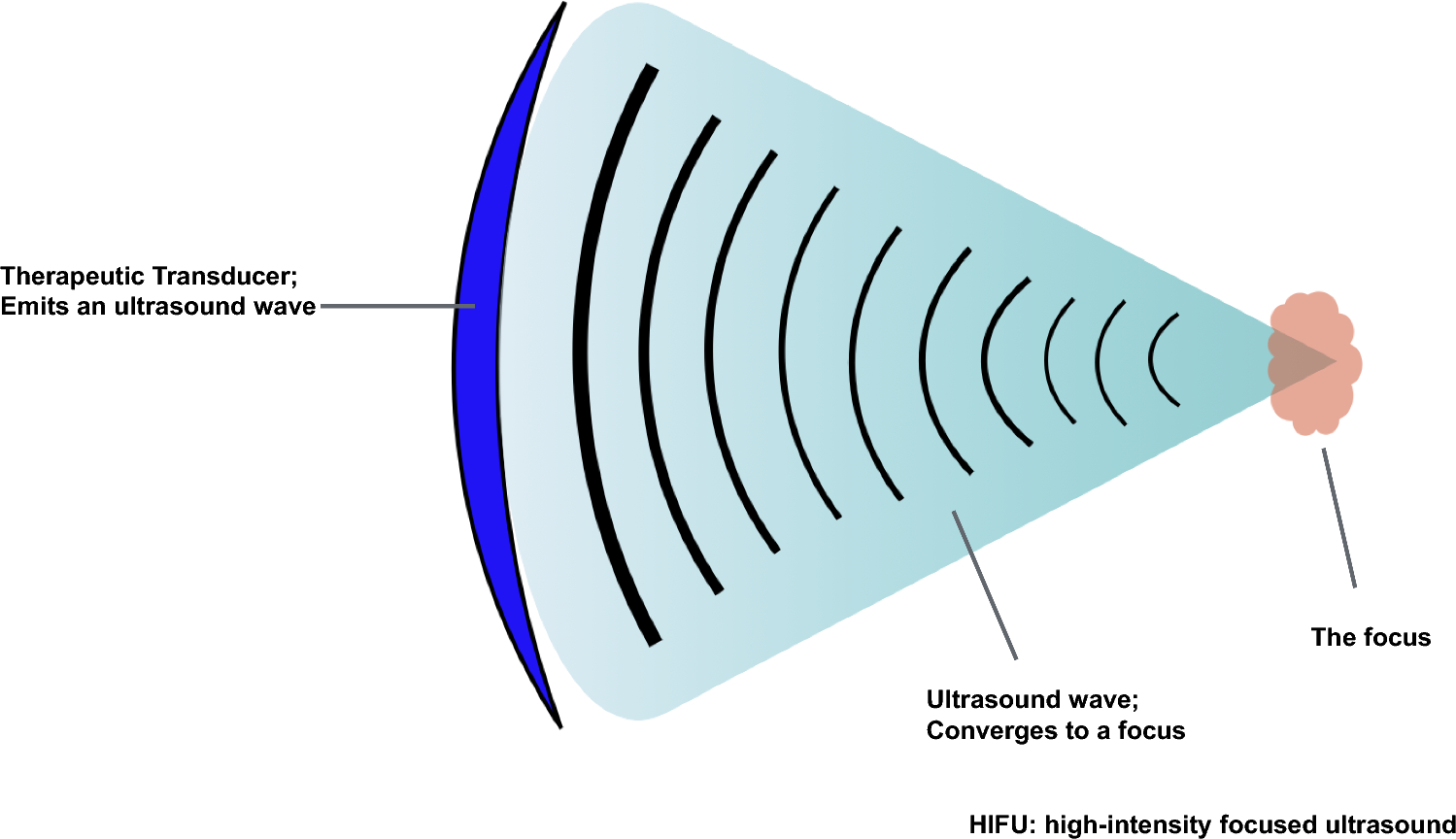 High-intensity focused ultrasound treatment for hepatocellular carcinoma