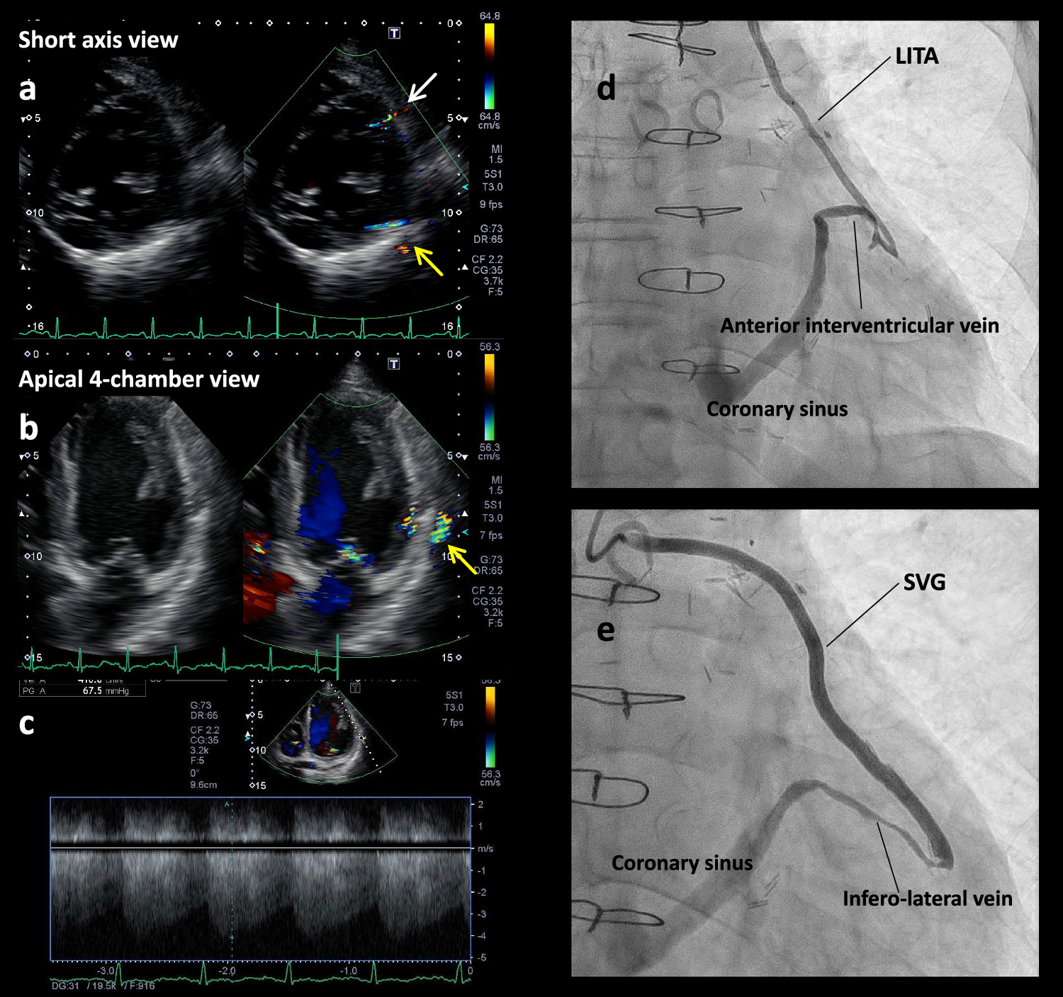 Iatrogenic aortocoronary arteriovenous fistula after coronary artery bypass grafting detected with transthoracic echocardiography