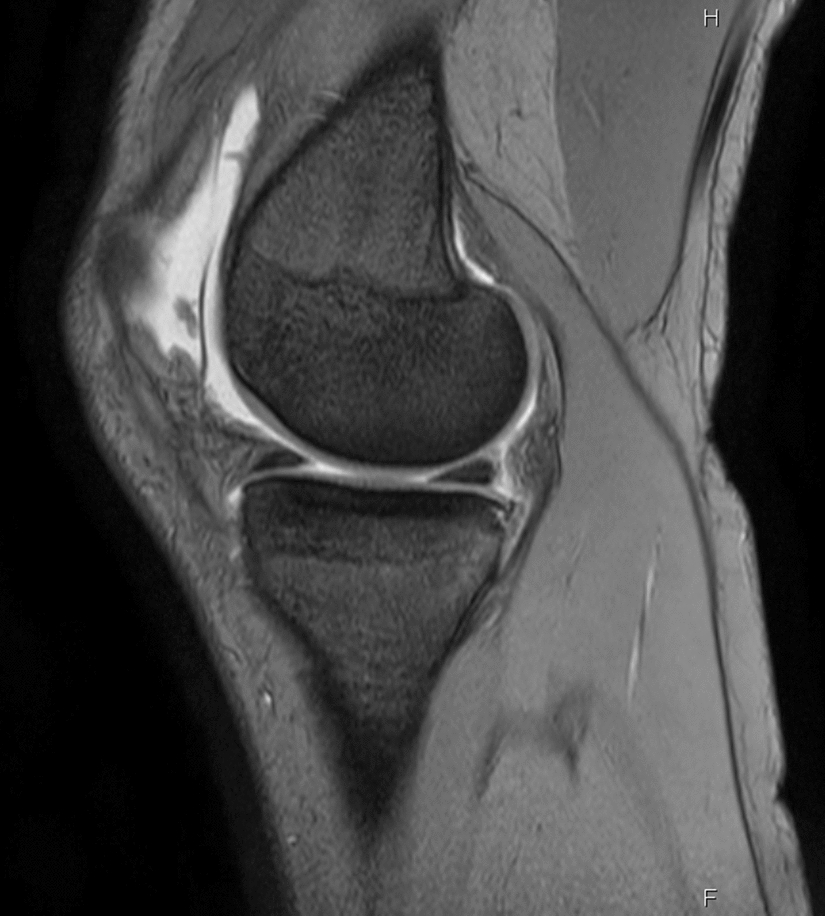 Identifying unstable ramp lesions using ultrasonography
