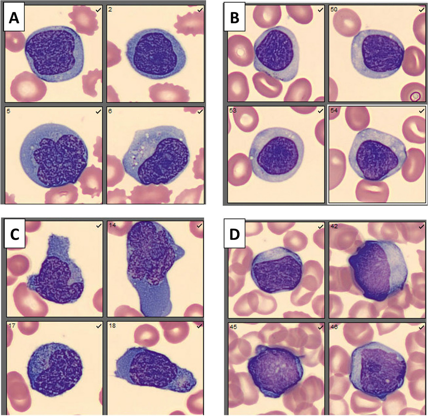 Carvykti CAR T-cell morphology in cellavision peripheral smear reviews
