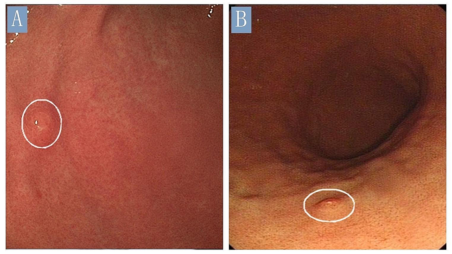 Isolated Langerhans cell histiocytosis in the stomach of adults: four-case series and literature review