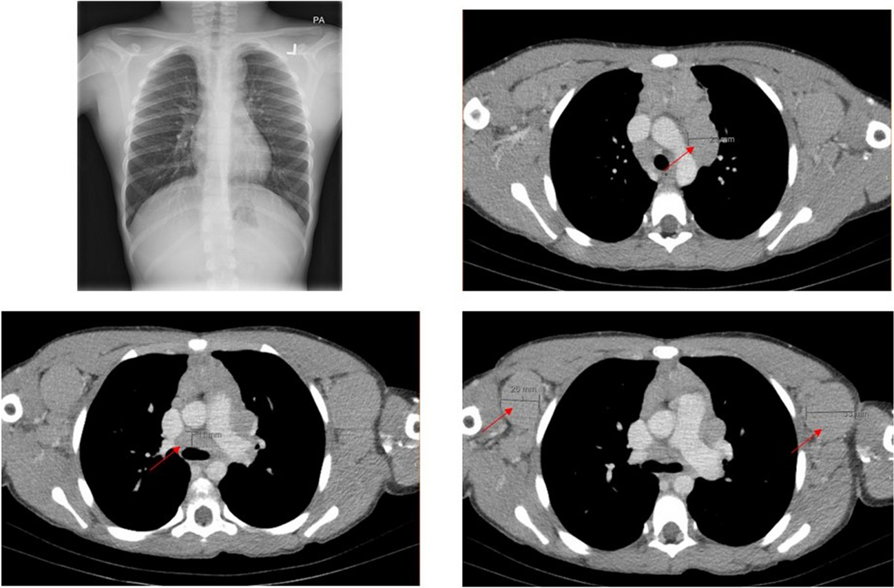 Gamma-delta T-cell acute lymphoblastic lymphoma/leukemia: a report of a rare entity