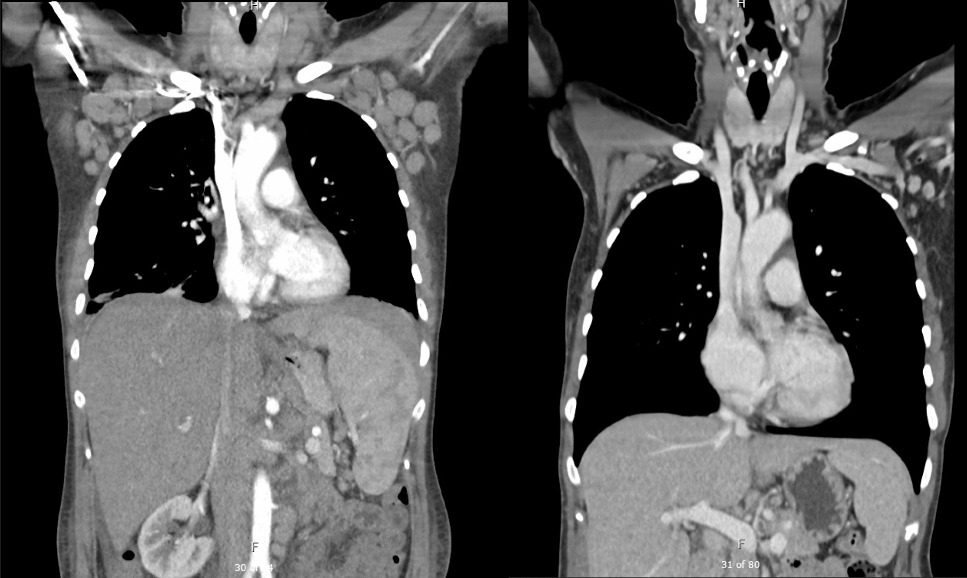 Highly atypical lymphoid proliferation after COVID-19 vaccine, with spontaneous regression