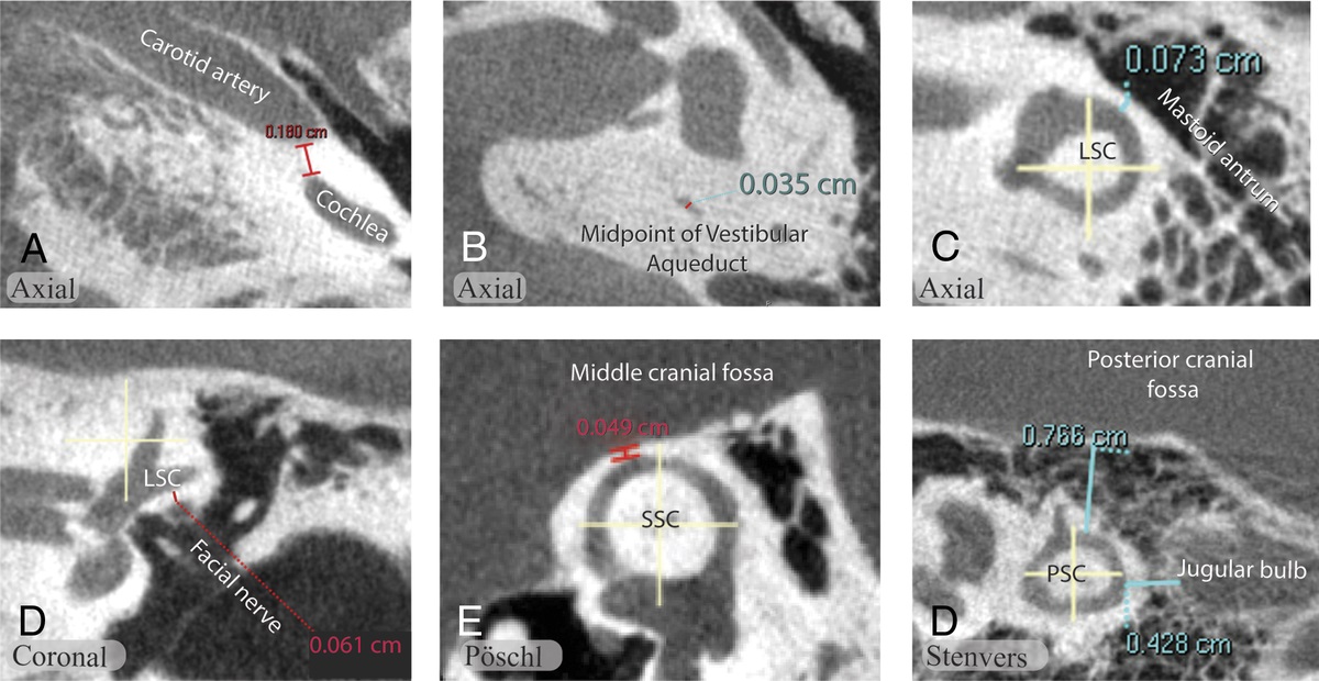 Superior Canal Dehiscence and the Risk of Additional Dehiscences: A Retrospective CT Cohort Study