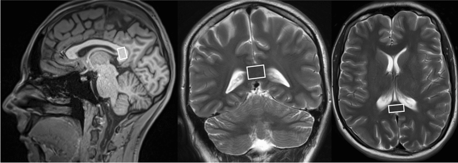 Metabolic changes assessed by 1H MR spectroscopy in the corpus callosum of post-COVID patients