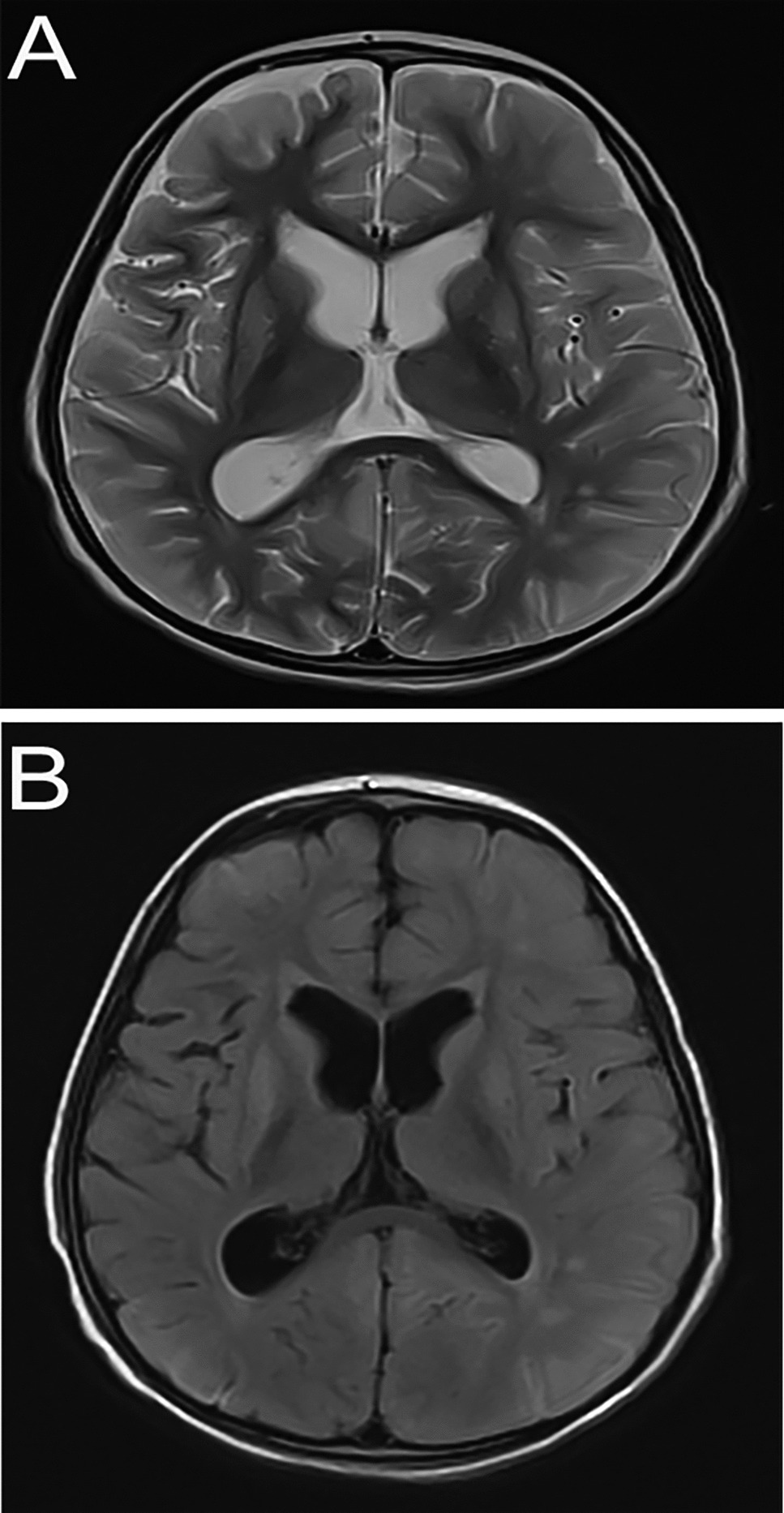Cerebral White Matter Alterations Associated With Oligodendrocyte Vulnerability in Organic Acidurias: Insights in Glutaric Aciduria Type I