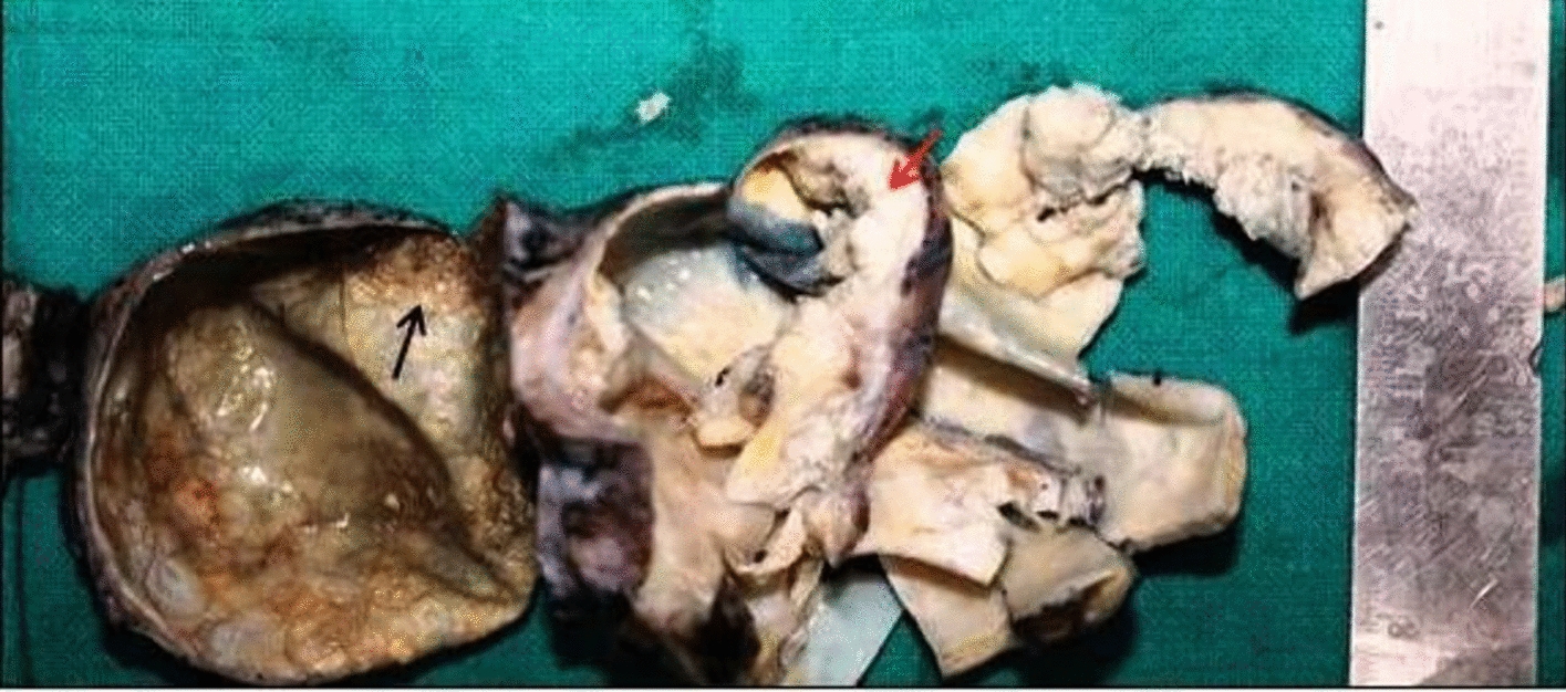 Secrets Within: Unraveling the Intriguing Plot of an Adenocarcinoma in a Mature Ovarian Teratoma