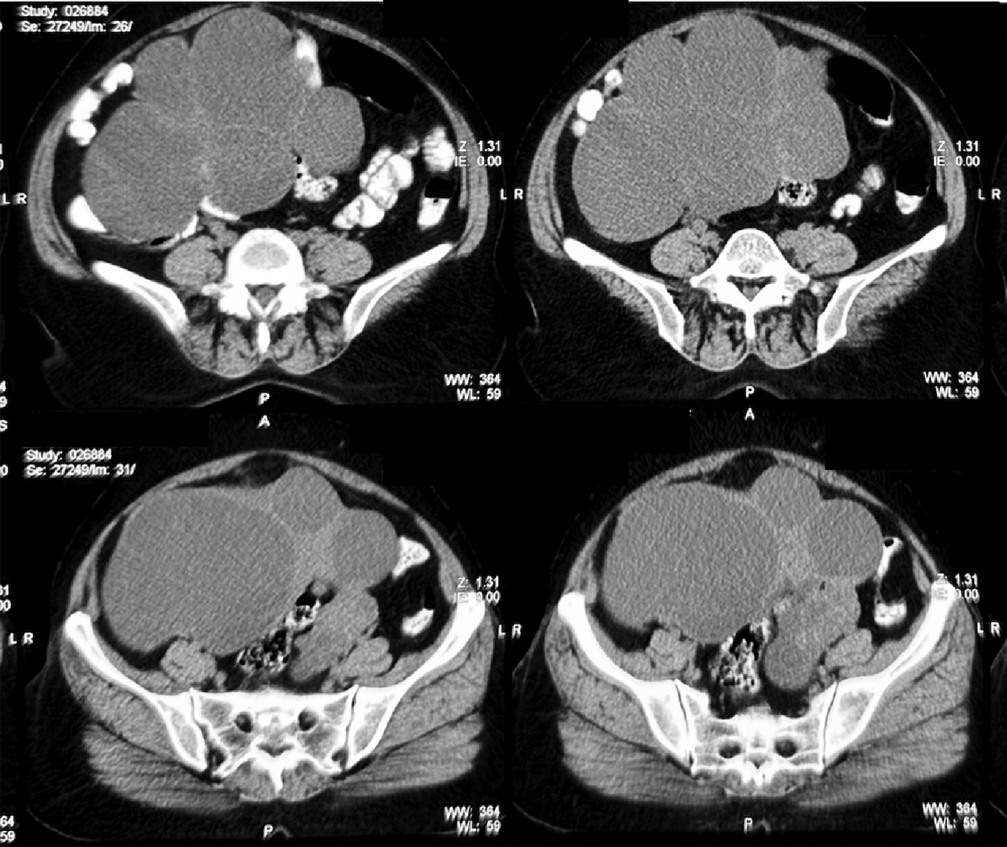 Primary Fallopian Tube Cancer: A Rare Interesting Case Report