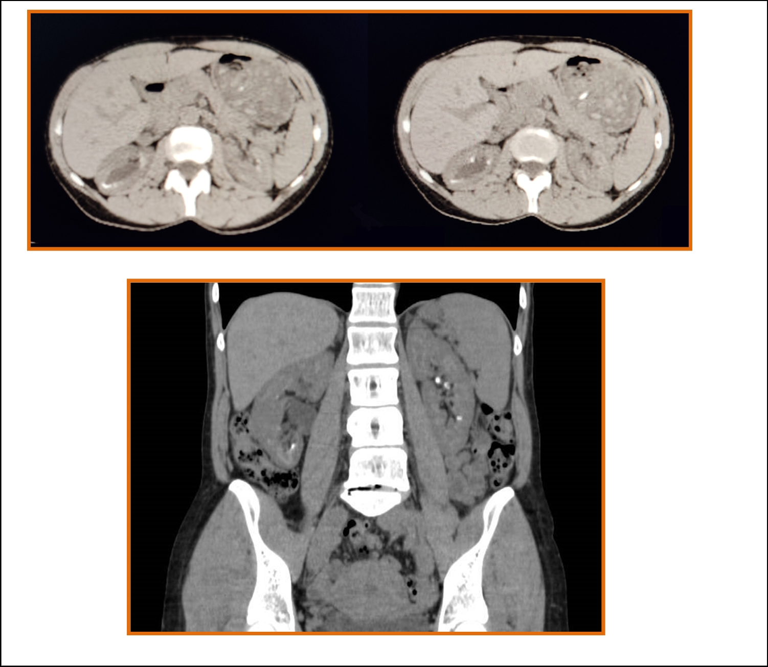 CYP24A1 Deficiency Mimicking Other Causes of Hypercalciuria and Nephrocalcinosis: A Case Report