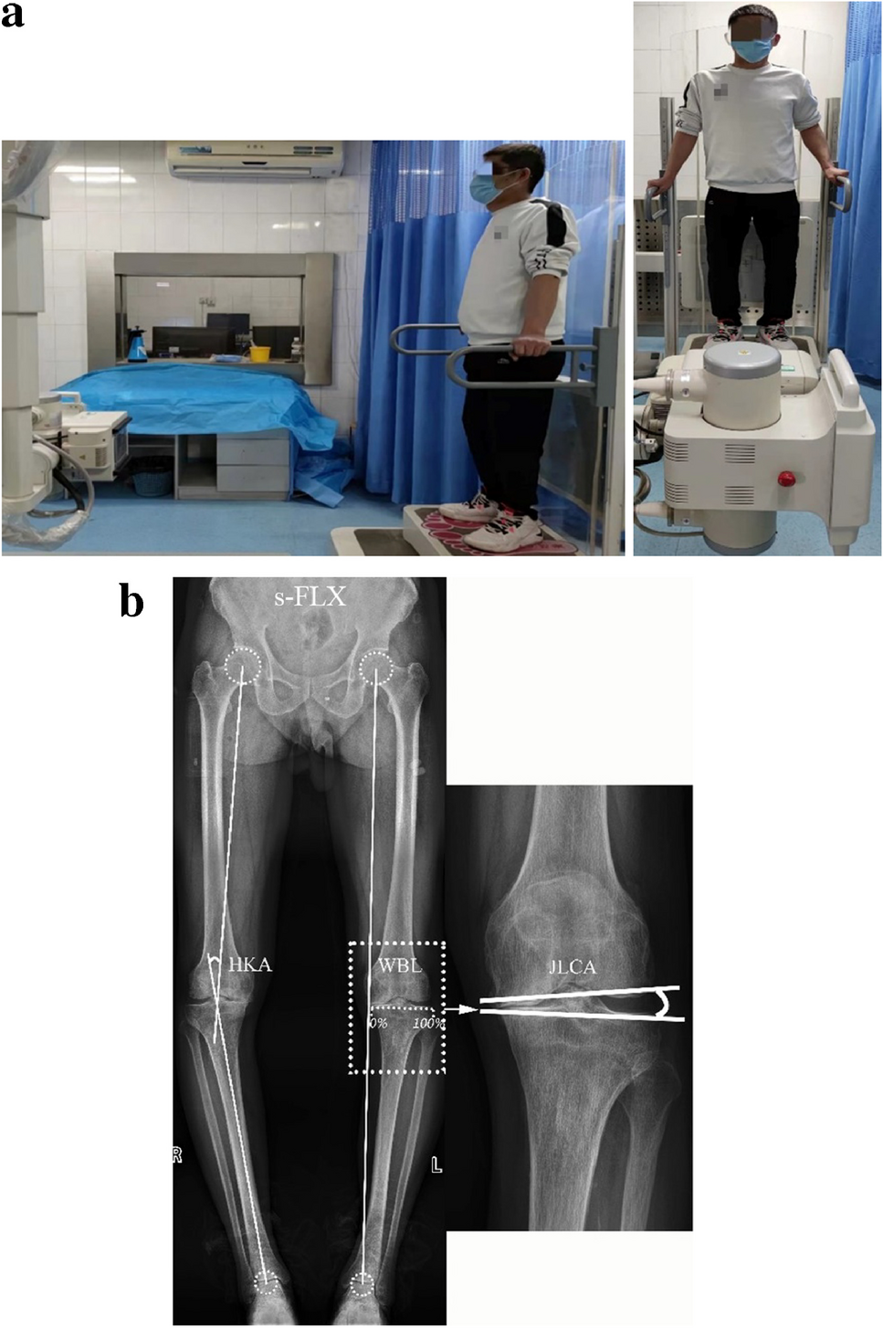 Assessment of lower limb alignment: supine weight-bearing CT scanograms compared with a standing full-length radiograph