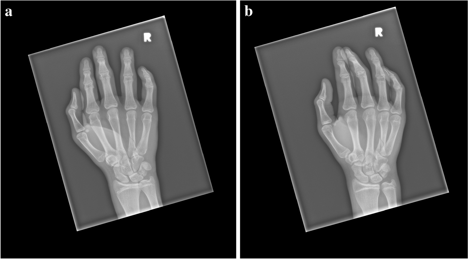 Painless Swelling of the 3rd Metacarpophalangeal Joint