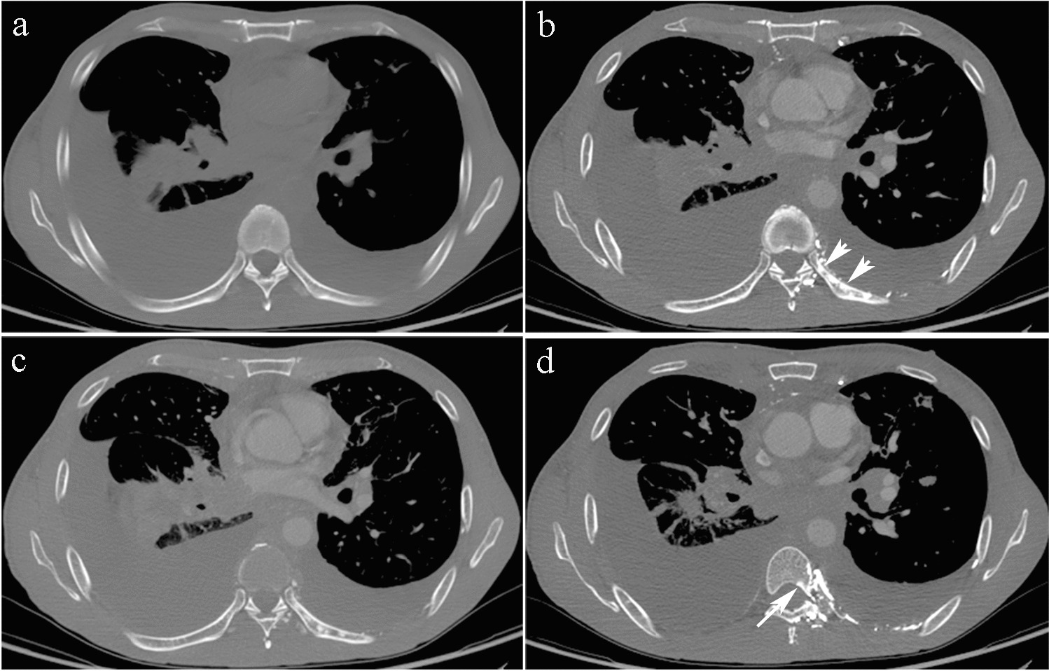Feasible CT features to distinguish incidental rib enhancement from sclerotic metastasis in patients with malignancies