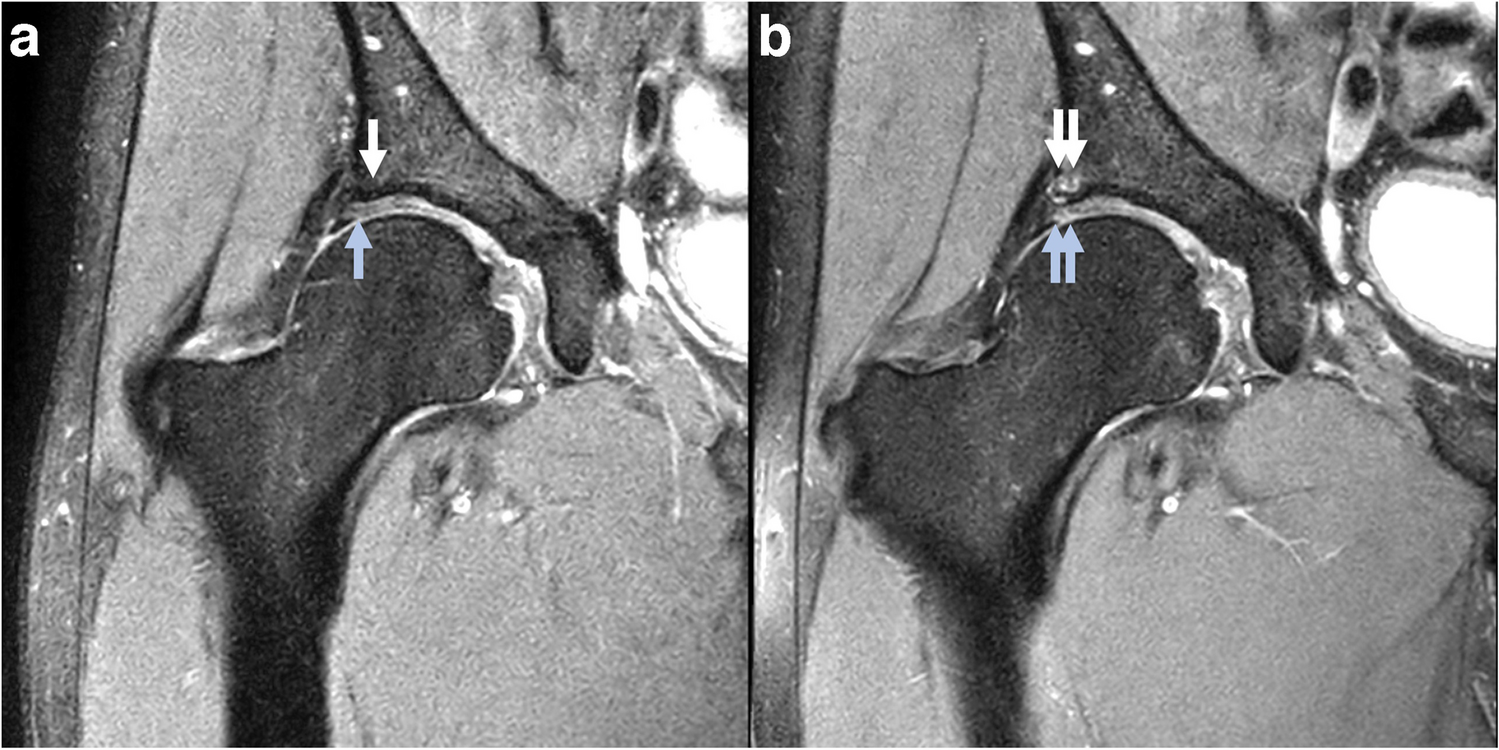 Defining hip osteoarthritis feature prevalence, severity, and change using the Scoring of Hip Osteoarthritis with MRI (SHOMRI)