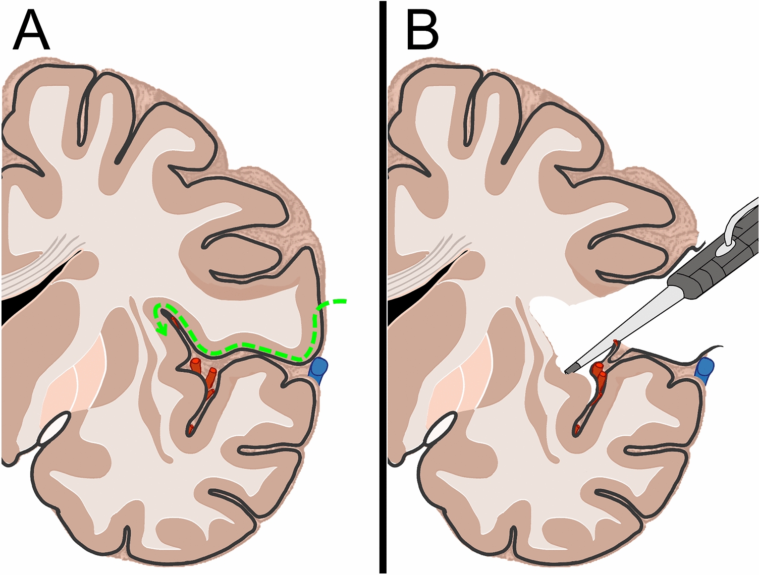 Frontal trans opercular approaches to the insula: building the mental picture from procedure-guided anatomical dissection