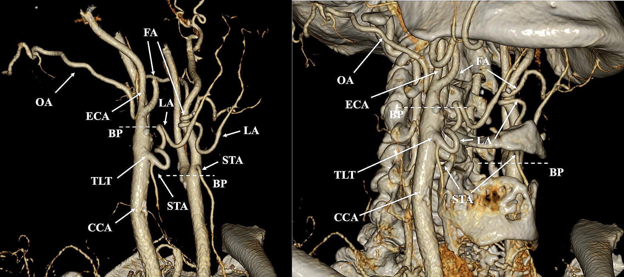 An ectopic thyrolingual trunk arising from the common carotid artery: a rare variant