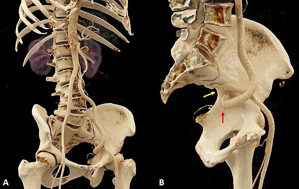 A complete vascular loop of the external iliac artery