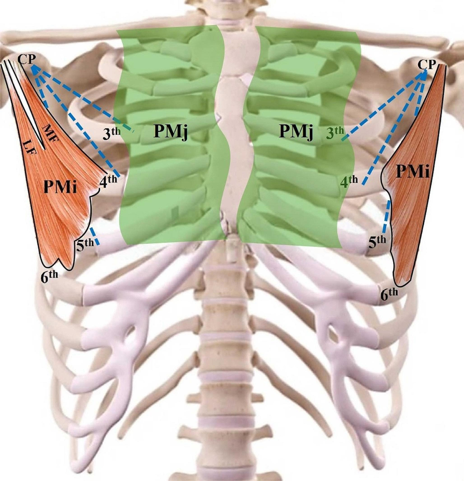 A case report of bilateral atypical origin of pectoralis minor