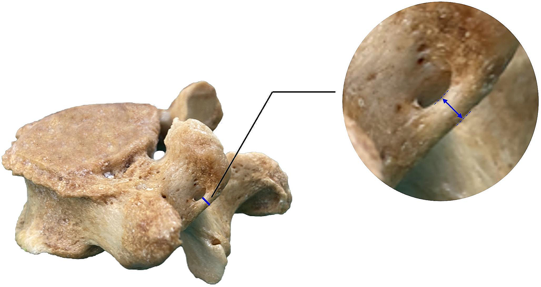 Anatomy of mamillo-accessory foramen and prevalence of ossified mamillo-accessory ligament in lumbar vertebrae related to age