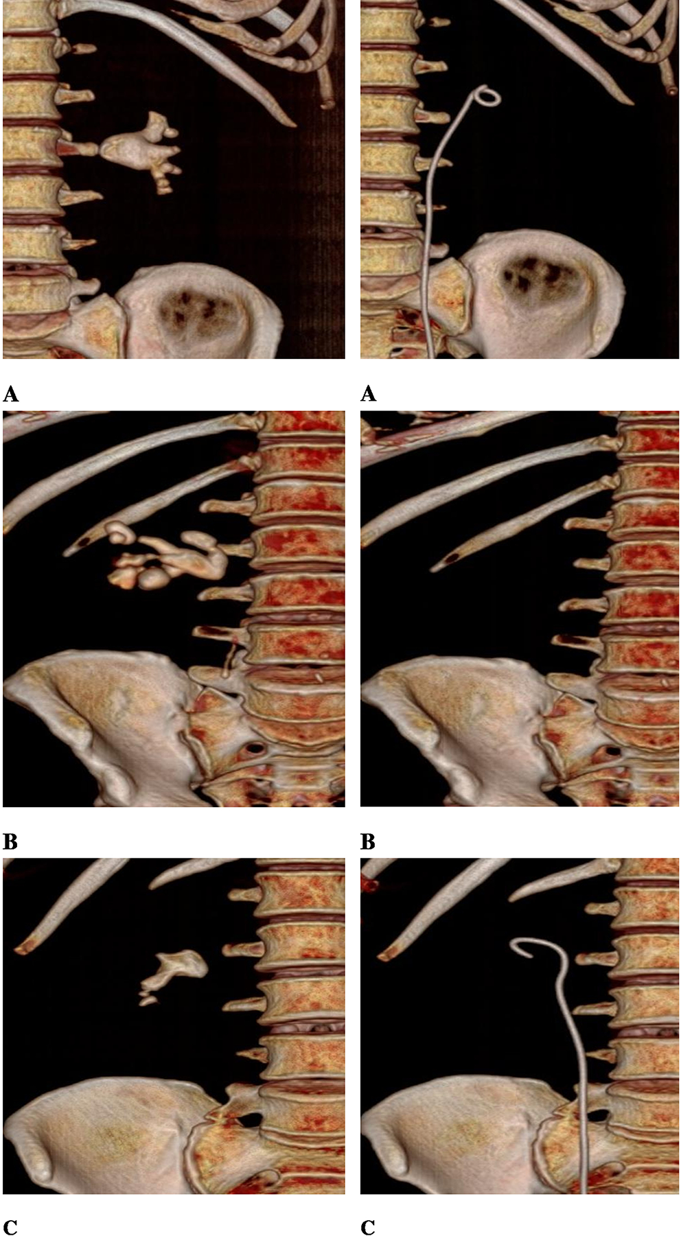 Successful treatment of staghorn stones with flexible ureteroscopy and thulium fiber laser (TFL) lithotripsy: initial experience with 32 cases