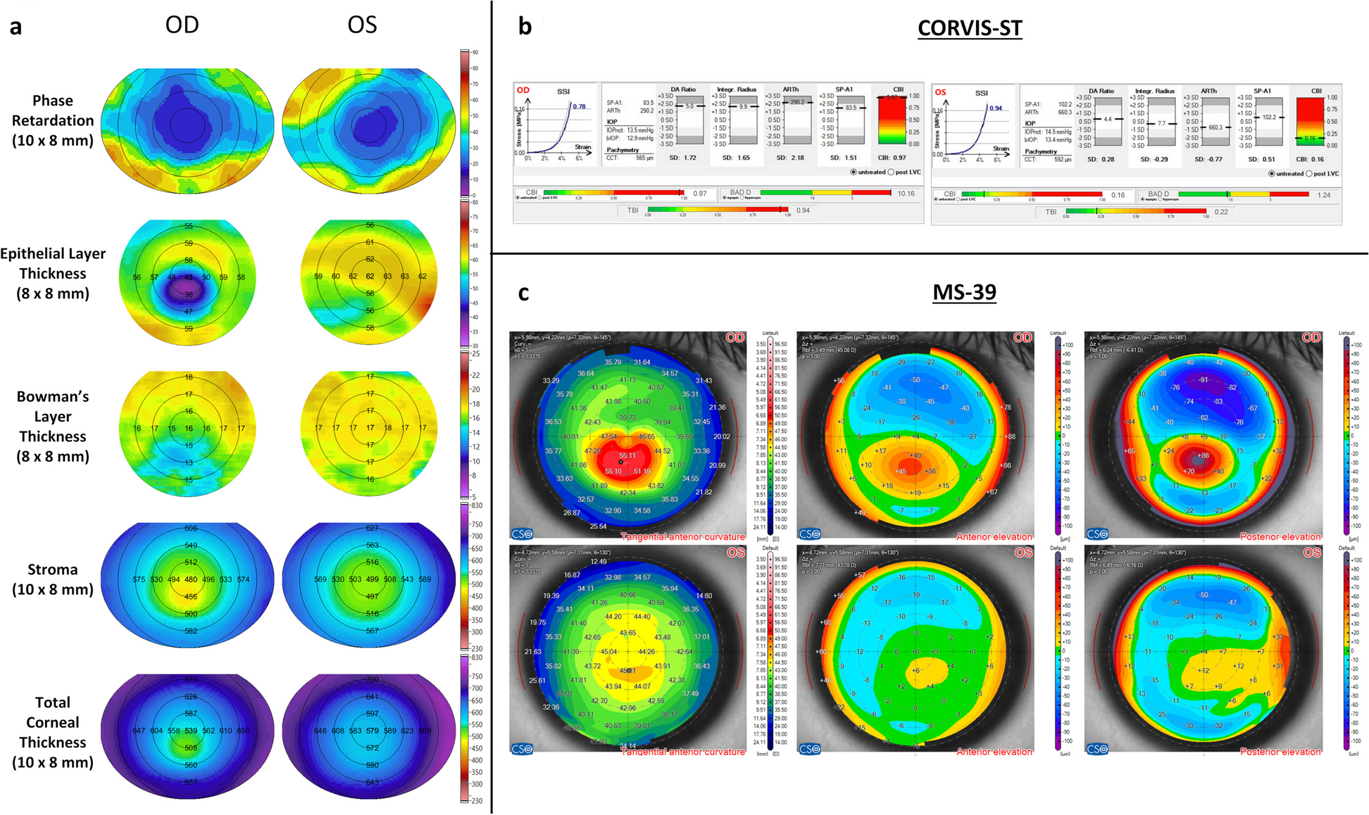 Insights into atypical segmental layer thicknesses and phase retardation in thick corneas using ultrahigh-resolution polarization-sensitive optical coherence tomography