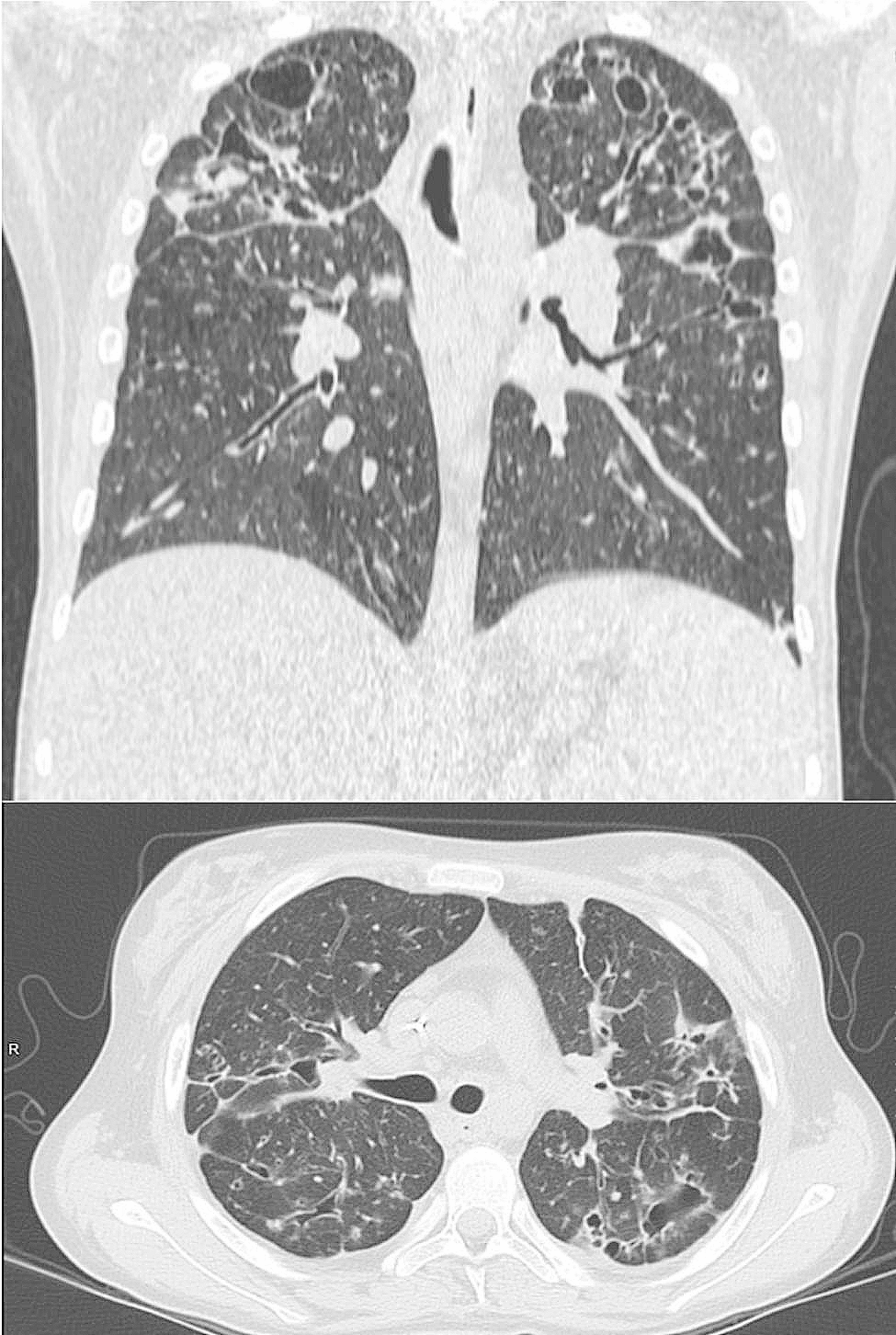 Lung transplant list withdrawal in a liver transplant patient thanks to elexacaftor-tezacaftor-ivacaftor: a case report